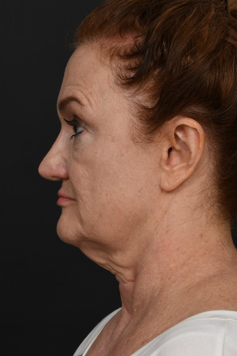 Facelift Before & After Gallery - Patient 535847 - Image 11