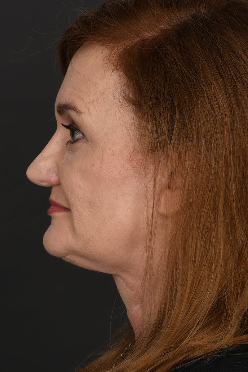 Facelift Before & After Gallery - Patient 535847 - Image 12