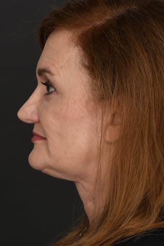 Facelift Before & After Gallery - Patient 535847 - Image 12