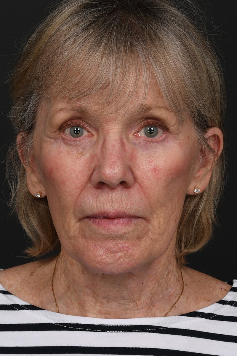 Facelift Before & After Gallery - Patient 836171 - Image 2