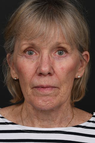 Composite Facelift Before & After Gallery - Patient 210810 - Image 2
