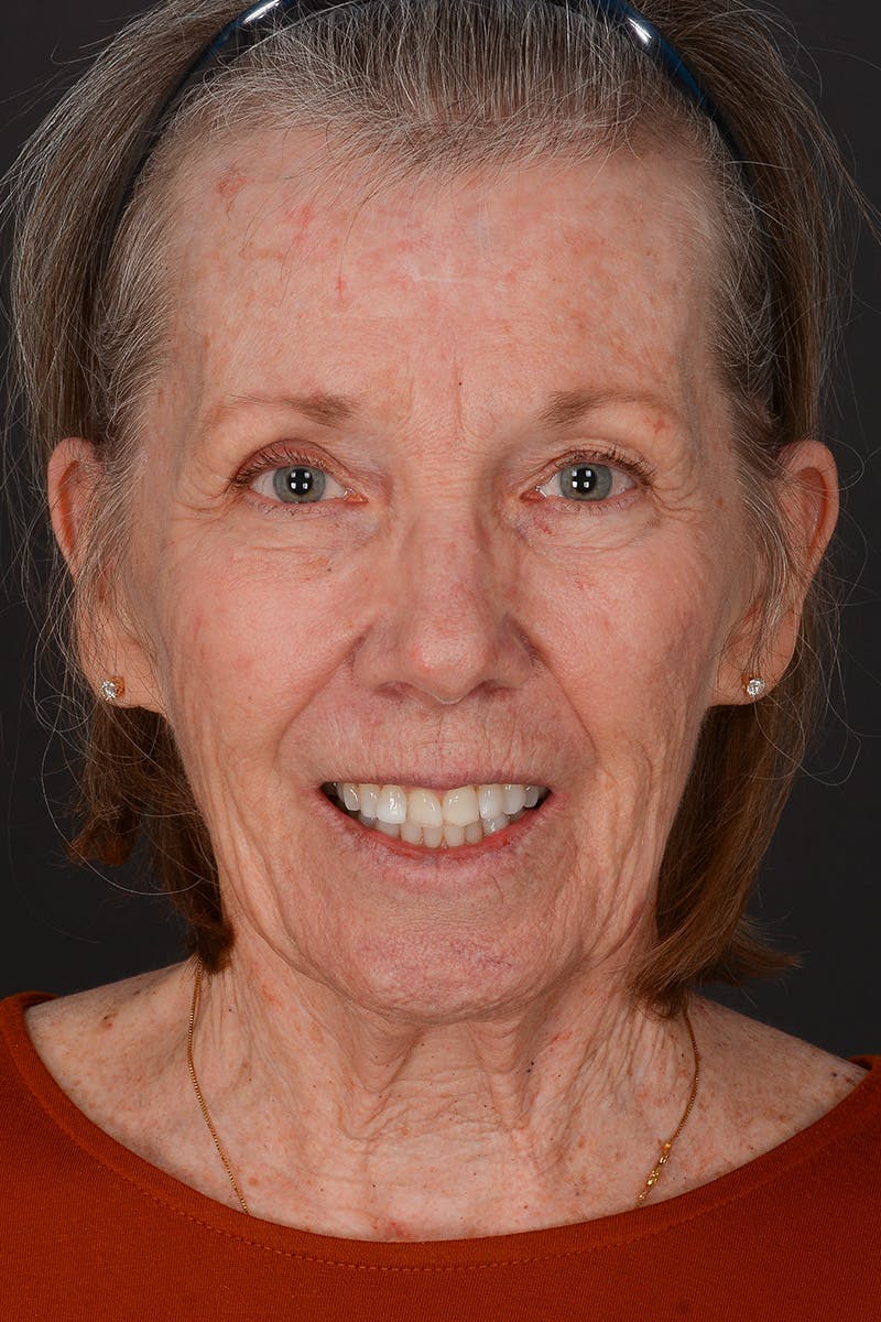 Facelift Before & After Gallery - Patient 836171 - Image 3