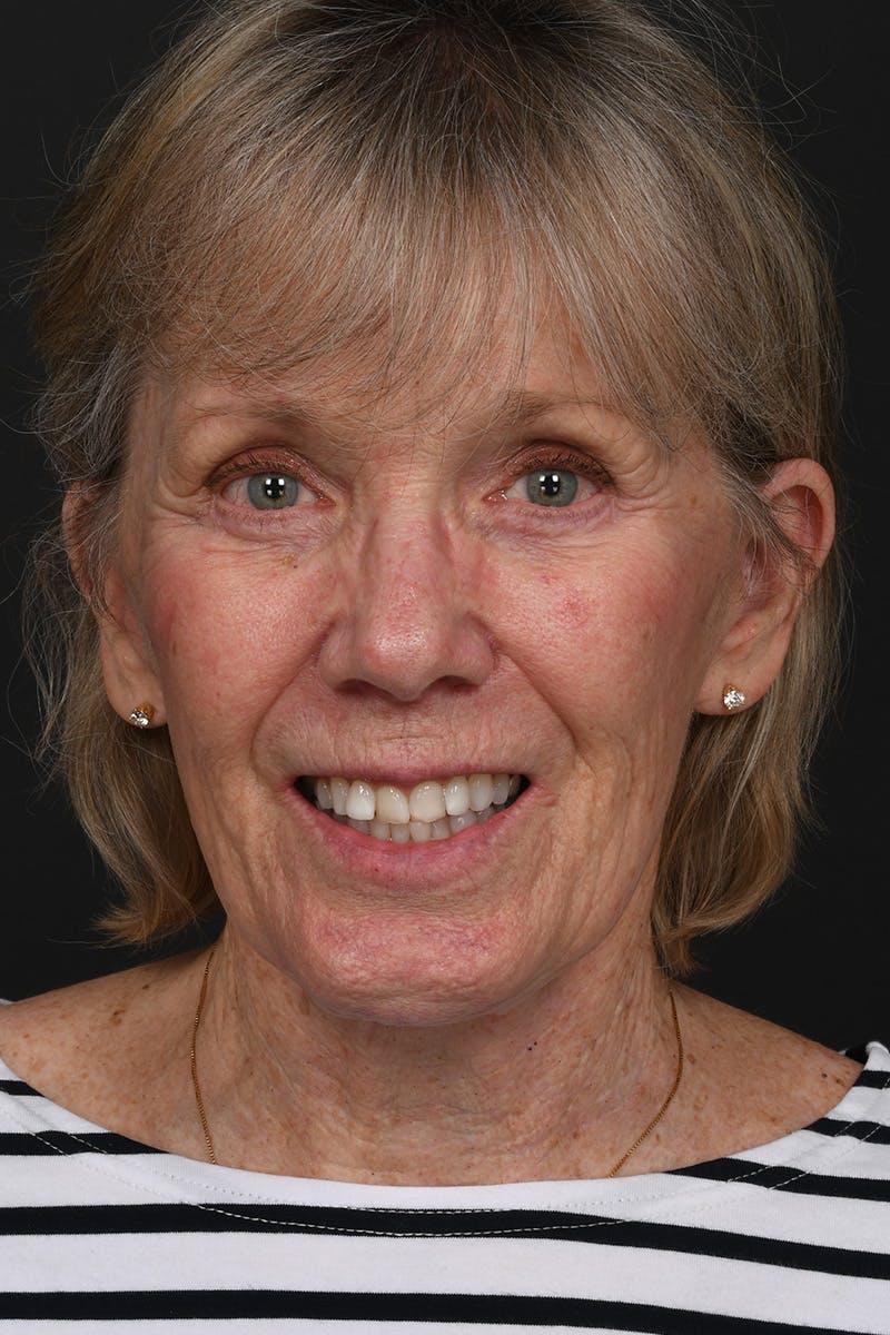 Facelift Before & After Gallery - Patient 836171 - Image 4