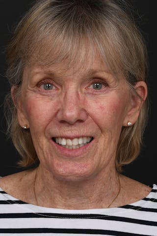 Composite Facelift Before & After Gallery - Patient 210810 - Image 4