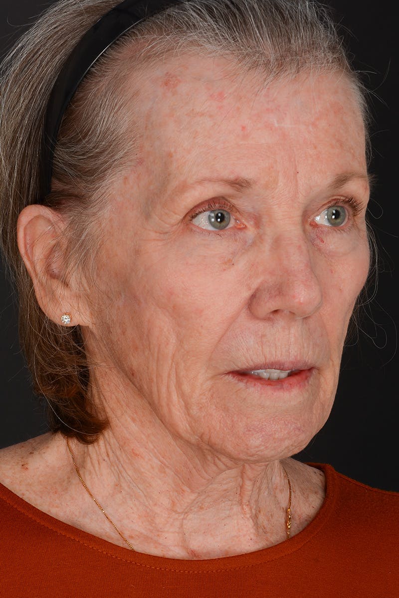 Facelift Before & After Gallery - Patient 836171 - Image 5