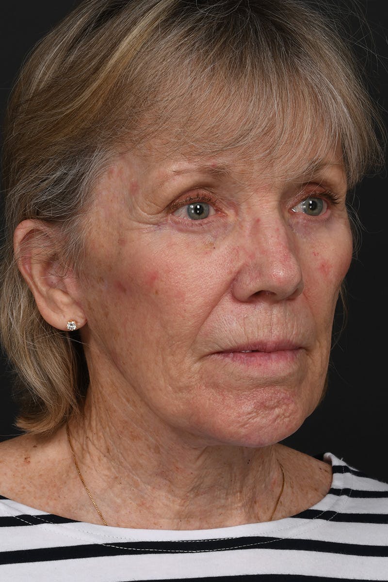Facelift Before & After Gallery - Patient 836171 - Image 6