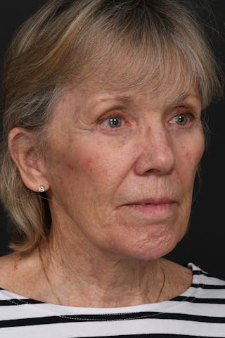 Composite Facelift Before & After Gallery - Patient 210810 - Image 6