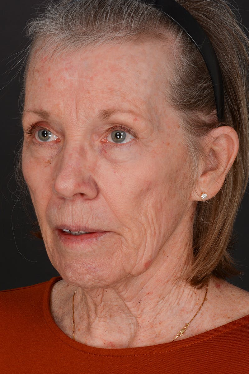 Facelift Before & After Gallery - Patient 836171 - Image 7