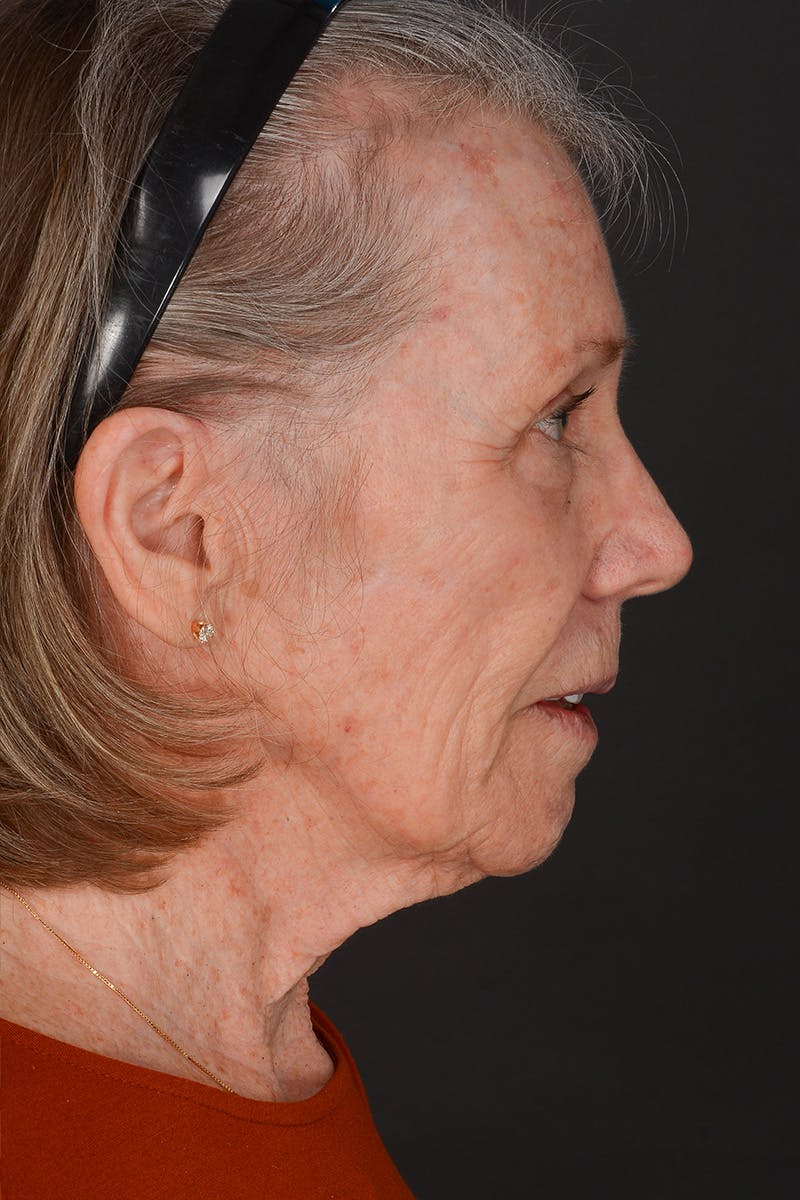 Facelift Before & After Gallery - Patient 836171 - Image 9