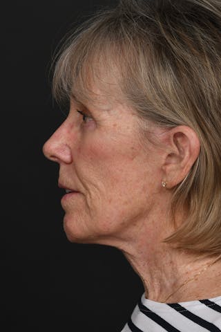 Composite Facelift Before & After Gallery - Patient 210810 - Image 12