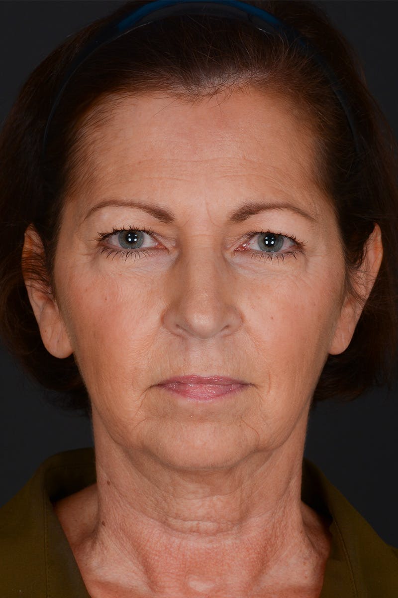 Composite Facelift Before & After Gallery - Patient 453532 - Image 1