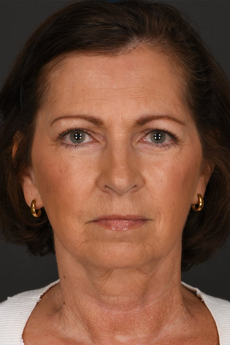 Composite Facelift Before & After Gallery - Patient 453532 - Image 2