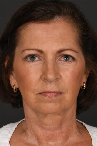 Facelift Before & After Gallery - Patient 400564 - Image 2