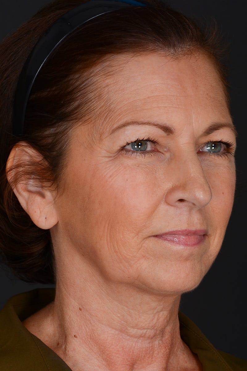 Composite Facelift Before & After Gallery - Patient 453532 - Image 3