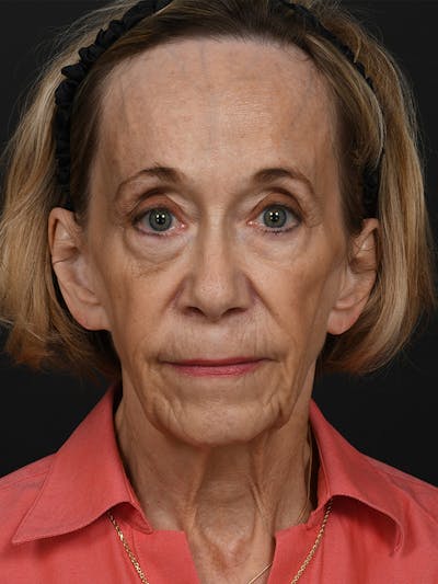 Facelift Before & After Gallery - Patient 341448 - Image 1