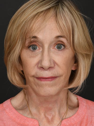 Facelift Before & After Gallery - Patient 341448 - Image 2