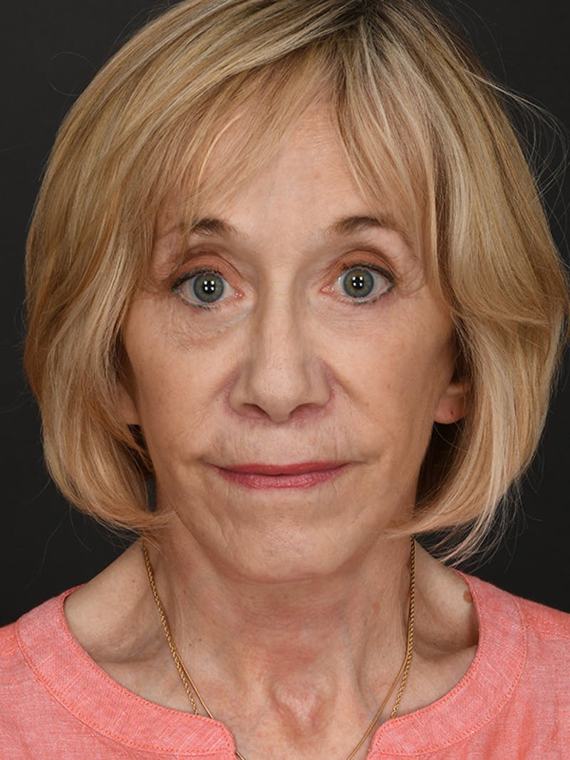 Facelift Before & After Gallery - Patient 341448 - Image 2