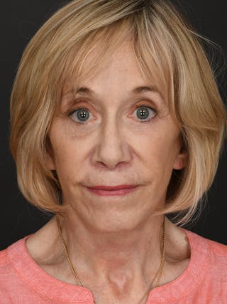 Facelift Before & After Gallery - Patient 341448 - Image 2