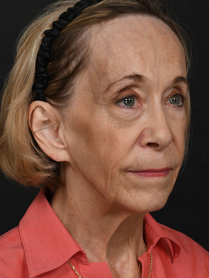 Facelift Before & After Gallery - Patient 341448 - Image 3