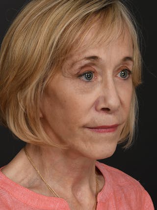 Facelift Before & After Gallery - Patient 341448 - Image 4