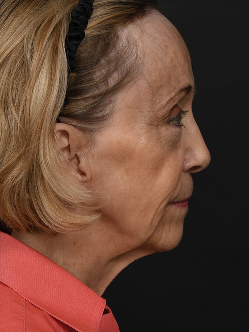 Facelift Before & After Gallery - Patient 341448 - Image 5