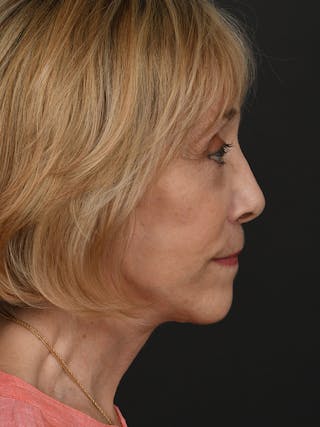 Facelift Before & After Gallery - Patient 341448 - Image 6