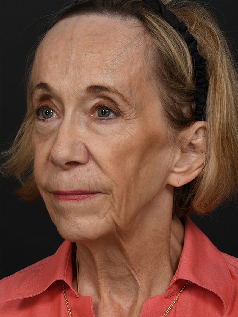 Facelift Before & After Gallery - Patient 341448 - Image 7