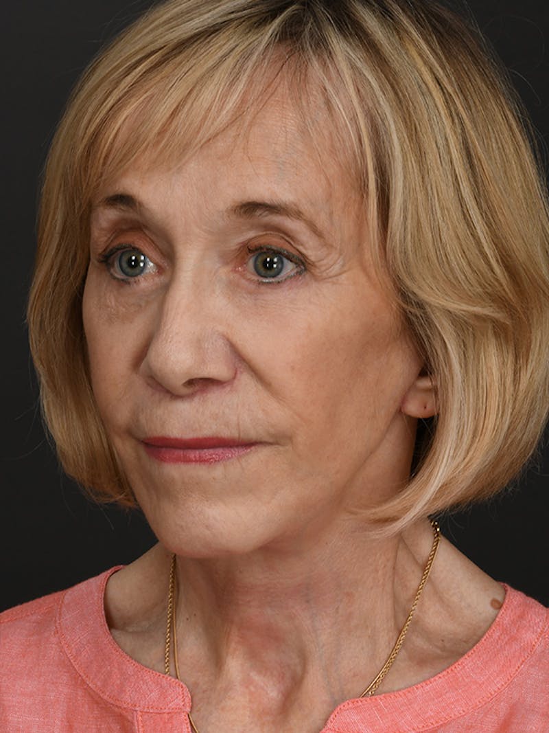 Facelift Before & After Gallery - Patient 341448 - Image 8