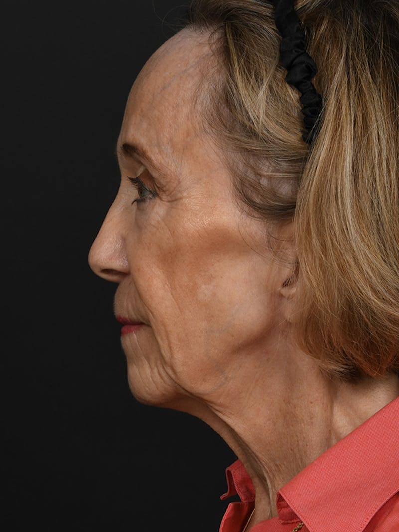Facelift Before & After Gallery - Patient 341448 - Image 9