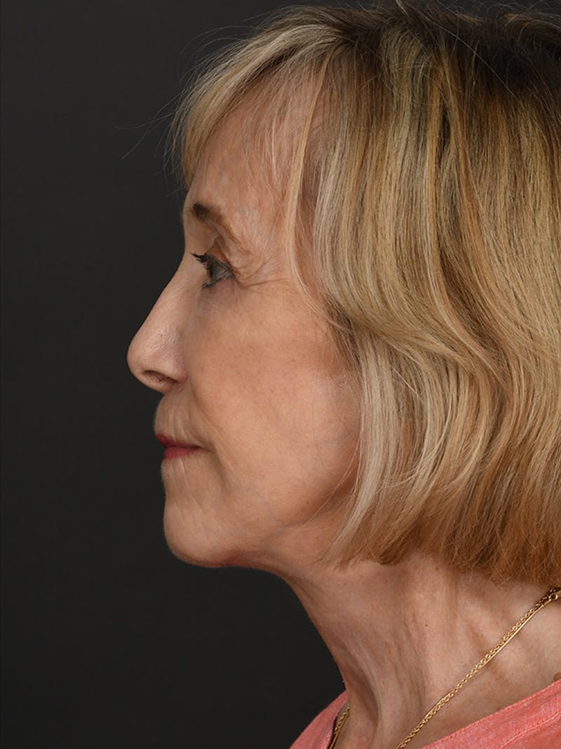 Facelift Before & After Gallery - Patient 341448 - Image 10