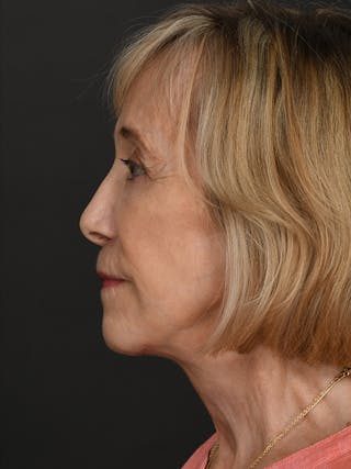 Facelift Before & After Gallery - Patient 341448 - Image 10