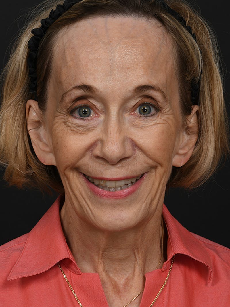 Facelift Before & After Gallery - Patient 341448 - Image 11