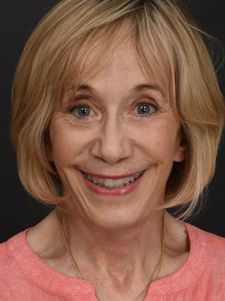 Facelift Before & After Gallery - Patient 341448 - Image 12