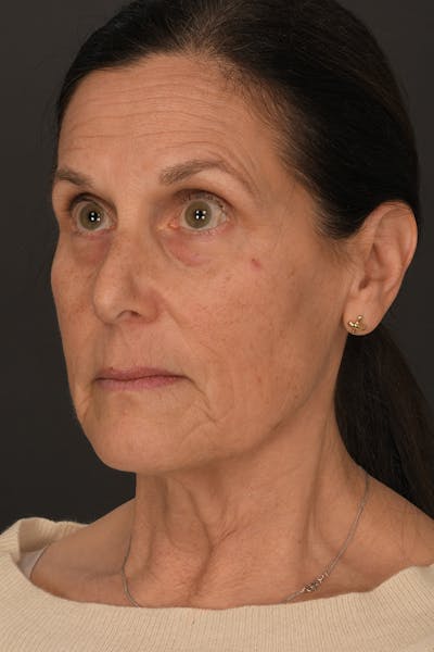 Facelift Before & After Gallery - Patient 296339 - Image 1