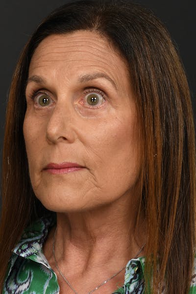 Facelift Before & After Gallery - Patient 296339 - Image 2