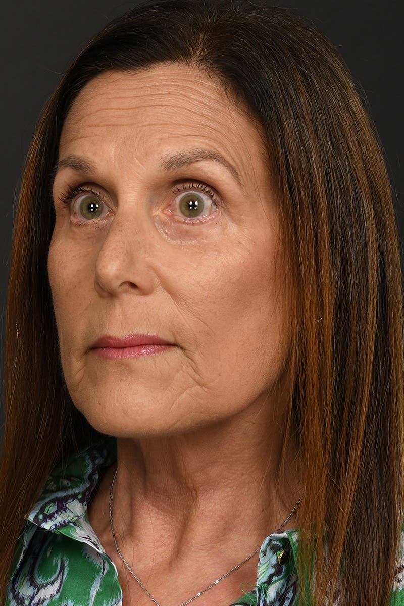 Composite Facelift Before & After Gallery - Patient 333856 - Image 2