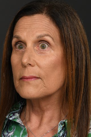 Facelift Before & After Gallery - Patient 296339 - Image 2