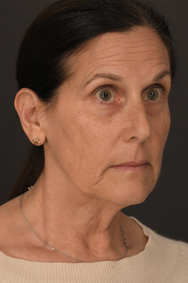 Composite Facelift Before & After Gallery - Patient 333856 - Image 3