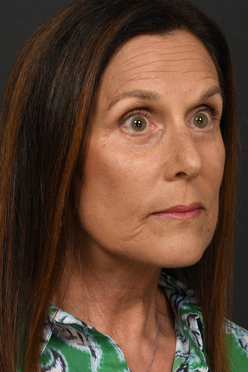 Composite Facelift Before & After Gallery - Patient 333856 - Image 4