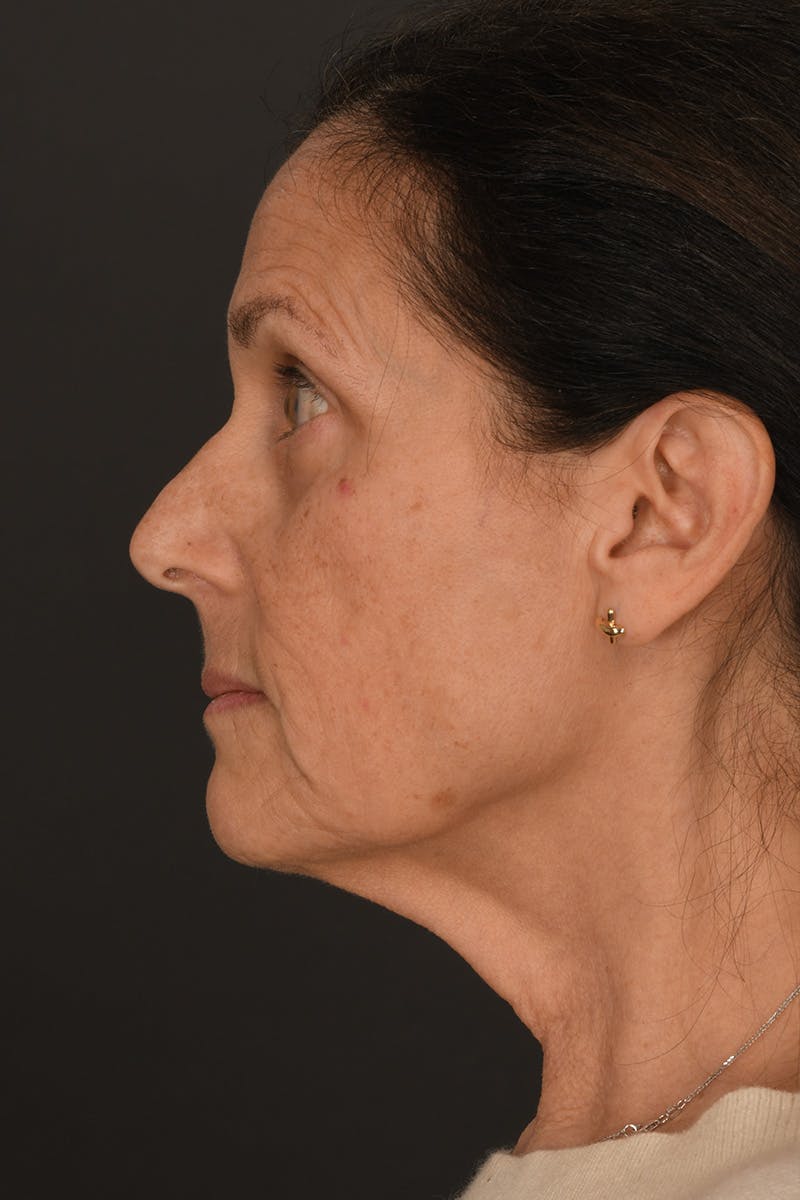 Composite Facelift Before & After Gallery - Patient 333856 - Image 7