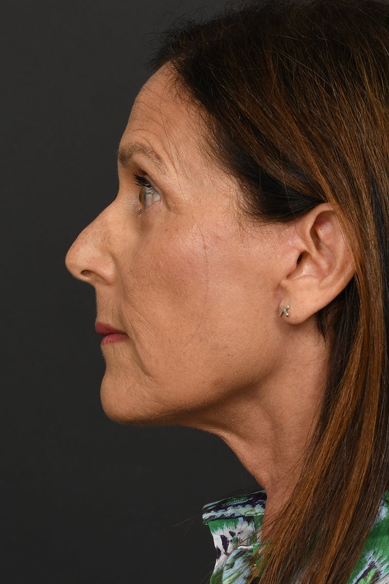 Composite Facelift Before & After Gallery - Patient 333856 - Image 8