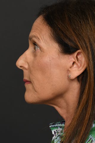 Facelift Before & After Gallery - Patient 296339 - Image 8