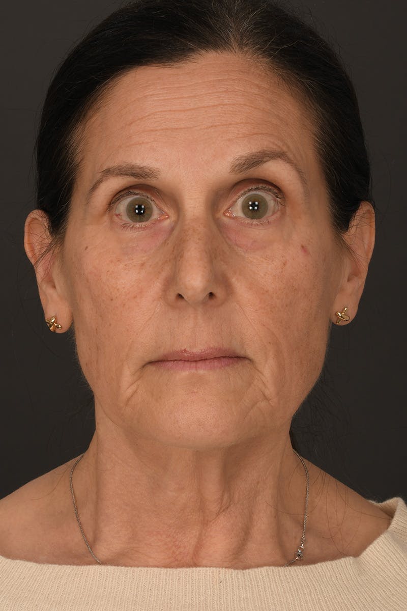 Composite Facelift Before & After Gallery - Patient 333856 - Image 9
