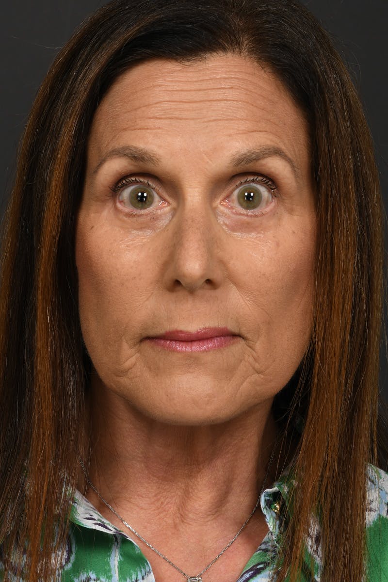 Composite Facelift Before & After Gallery - Patient 333856 - Image 10