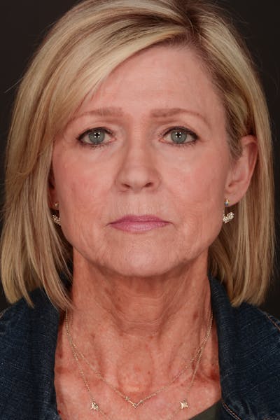 Facelift Before & After Gallery - Patient 407471 - Image 1
