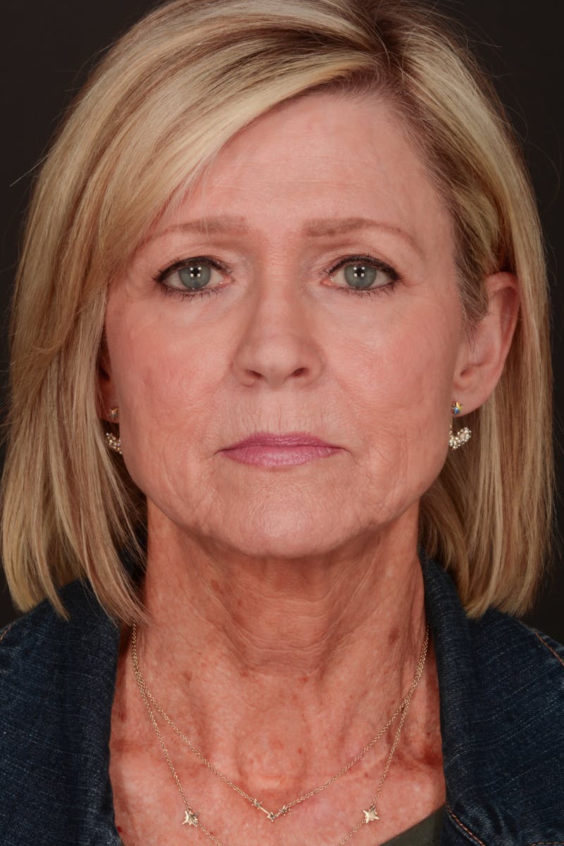 Composite Facelift Before & After Gallery - Patient 302695 - Image 1