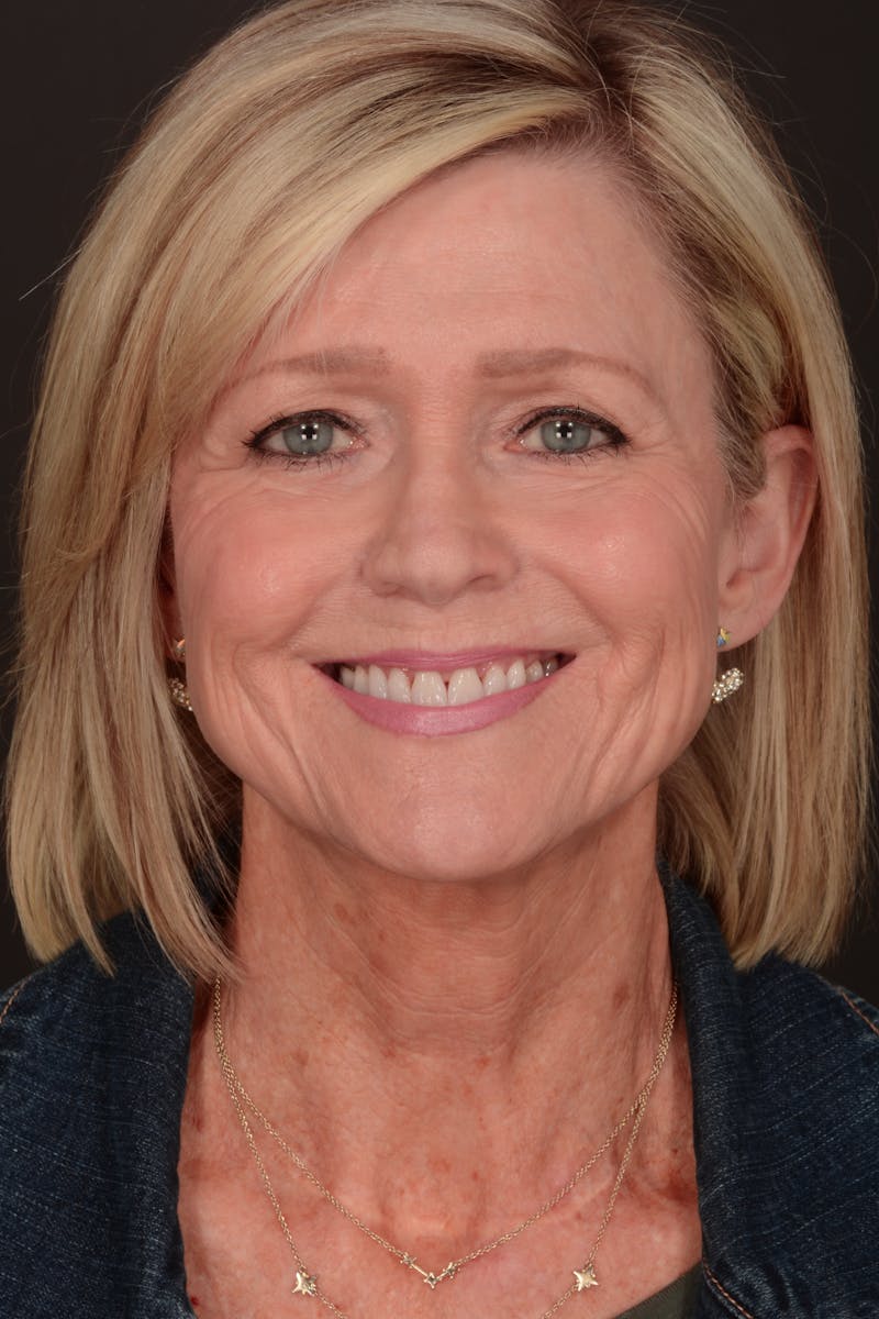 Composite Facelift Before & After Gallery - Patient 302695 - Image 3