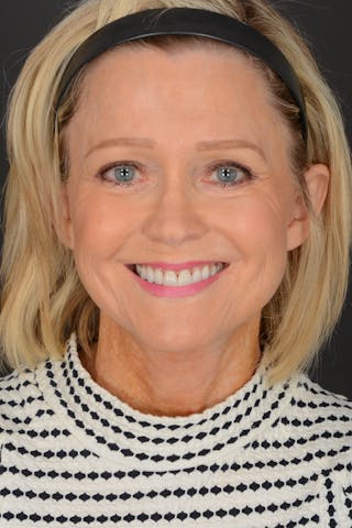 Brow Lift Before & After Gallery - Patient 126165 - Image 4