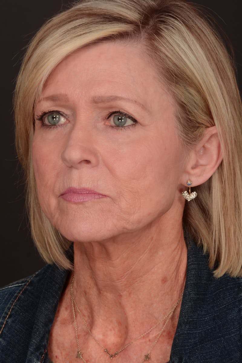 Composite Facelift Before & After Gallery - Patient 302695 - Image 5