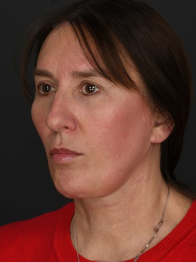 Composite Facelift Before & After Gallery - Patient 334203 - Image 2